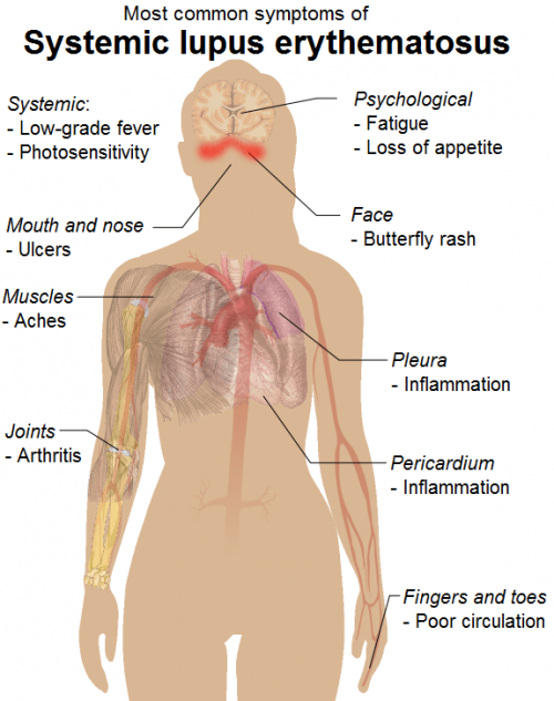 symptoms of lupus